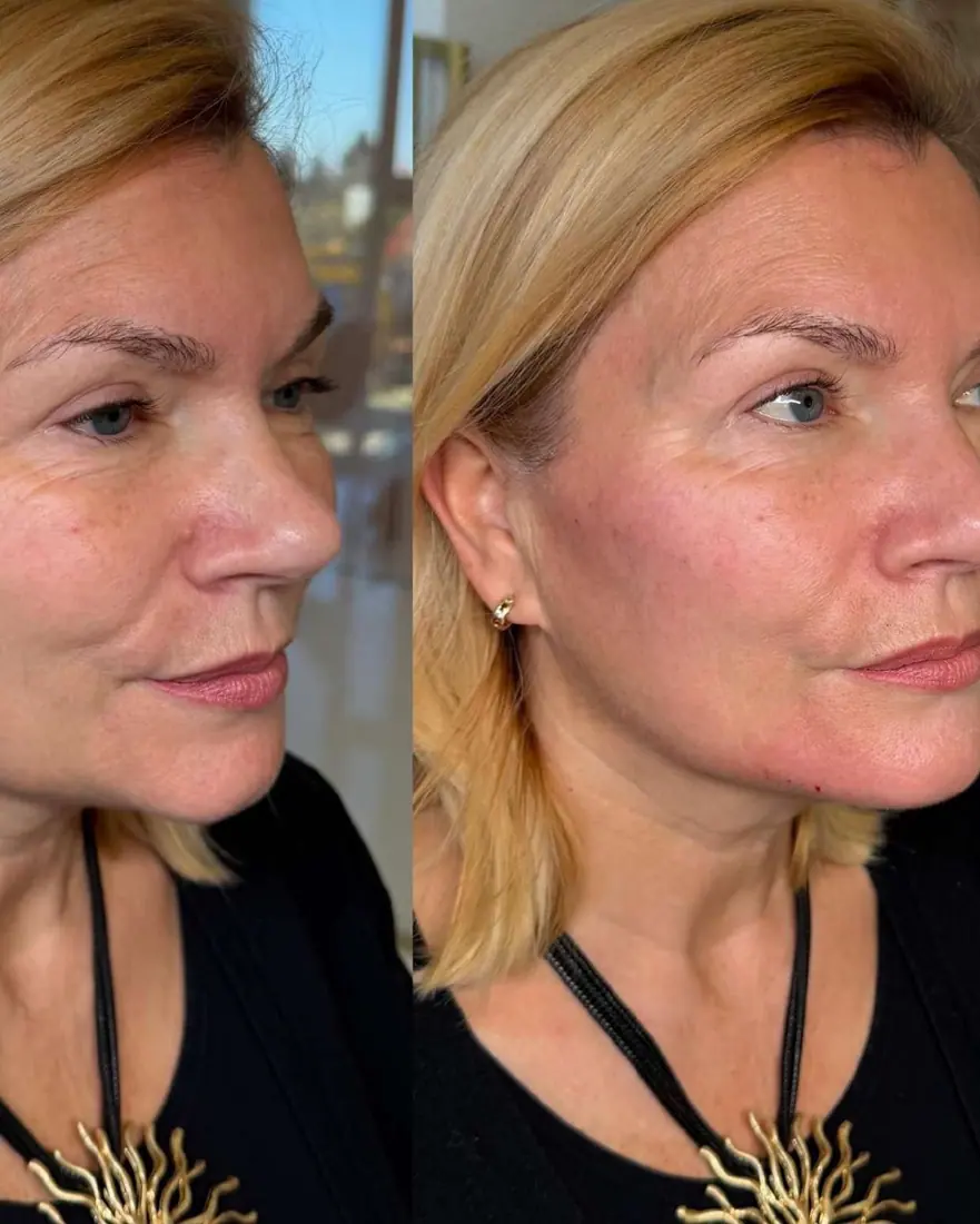 Naturalna wolumetria twarzy Piła — Dominika — efekt zabiegu 2, Beauty Station Piła
