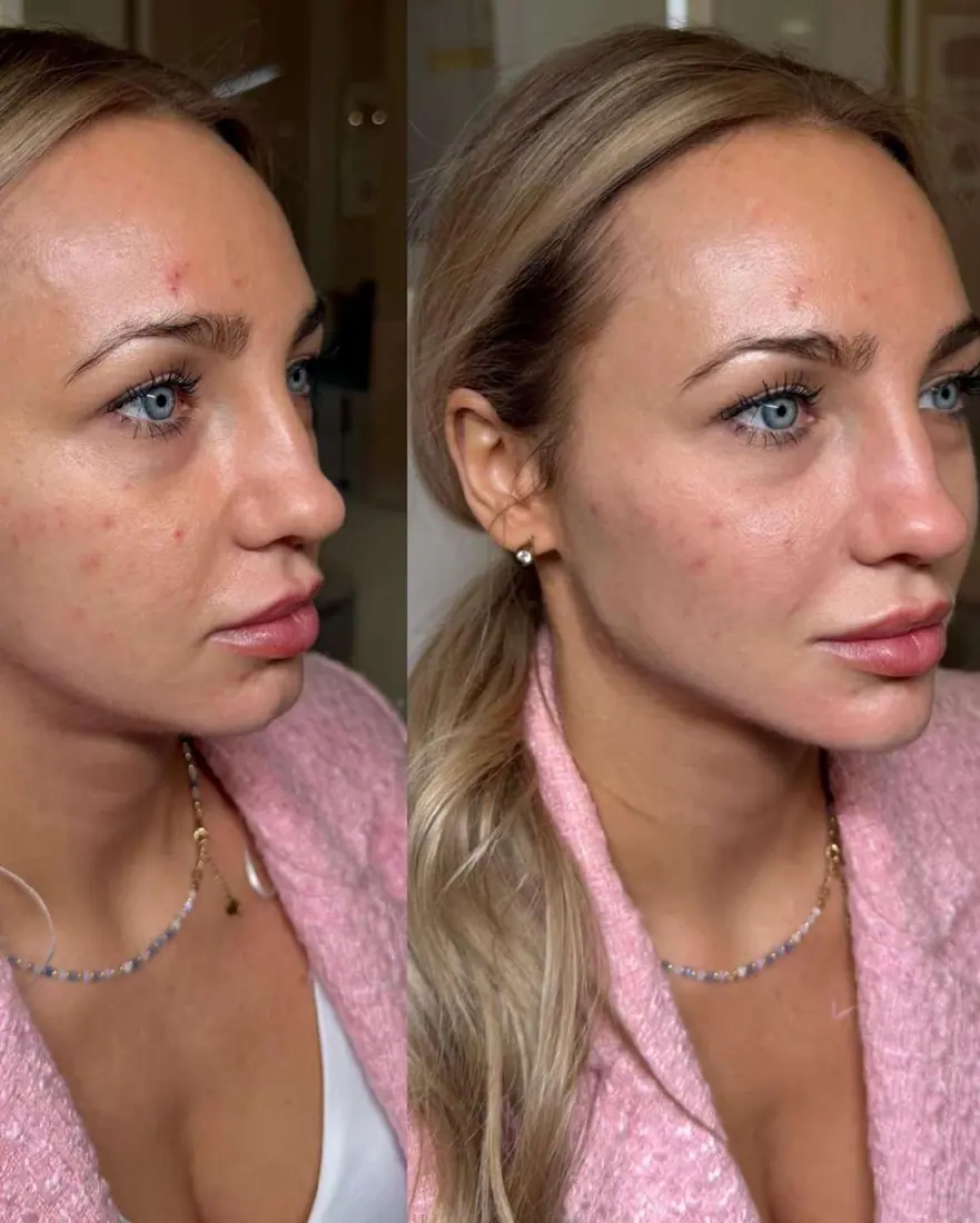 Naturalna wolumetria twarzy Piła — Dominika — efekt zabiegu 3, Beauty Station Piła
