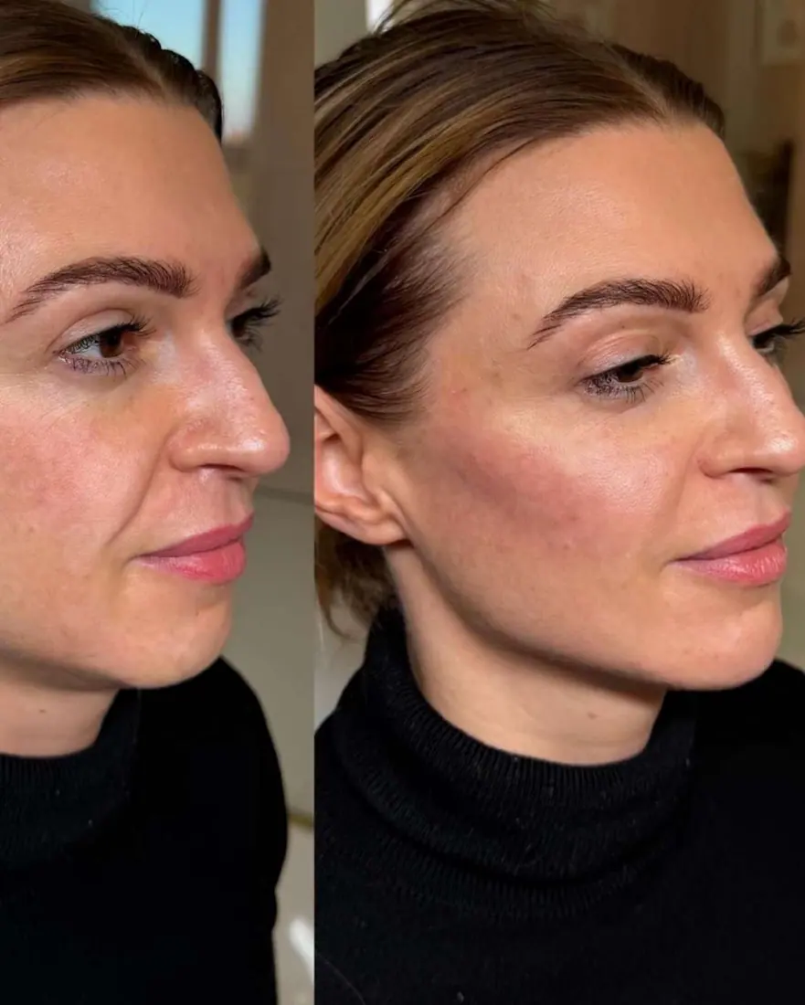 Naturalna wolumetria twarzy Piła — Dominika — efekt zabiegu 1, Beauty Station Piła