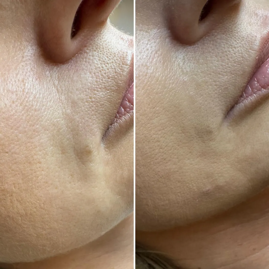 Niwelowanie zmarszczek (bruzdy nosowo-wargowe, linie marionetki) Piła — Dominika — efekt zabiegu 1, Beauty Station Piła
