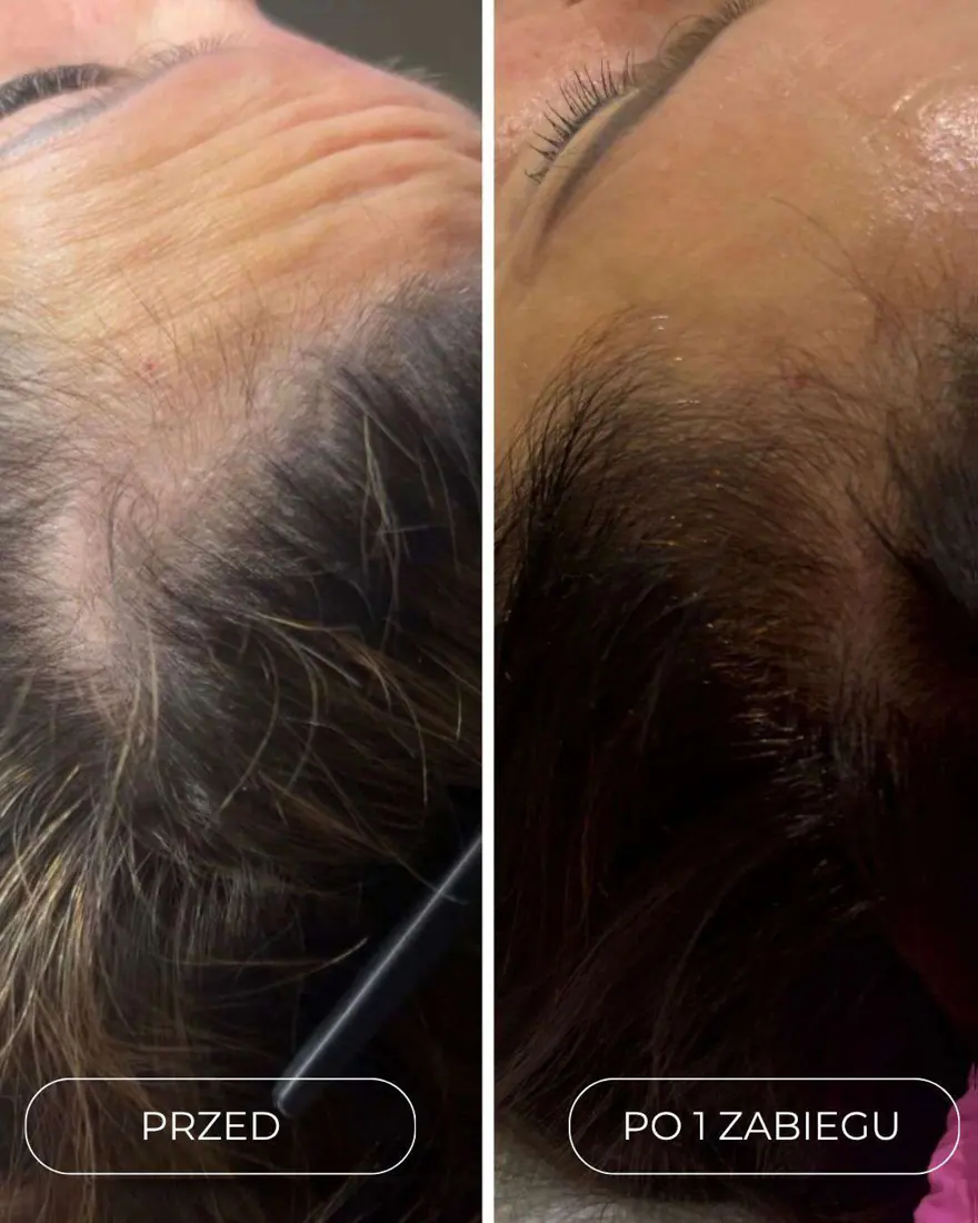 Mezoterapia igłowa skóry głowy (Dr. CYJ Hair Filler) Piła — Justyna — efekt zabiegu 1, Beauty Station Piła