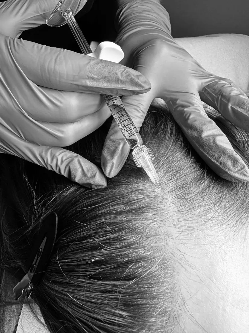 Mezoterapia igłowa skóry głowy (Dr. CYJ Hair Filler) Piła — Justyna — efekt zabiegu 2, Beauty Station Piła