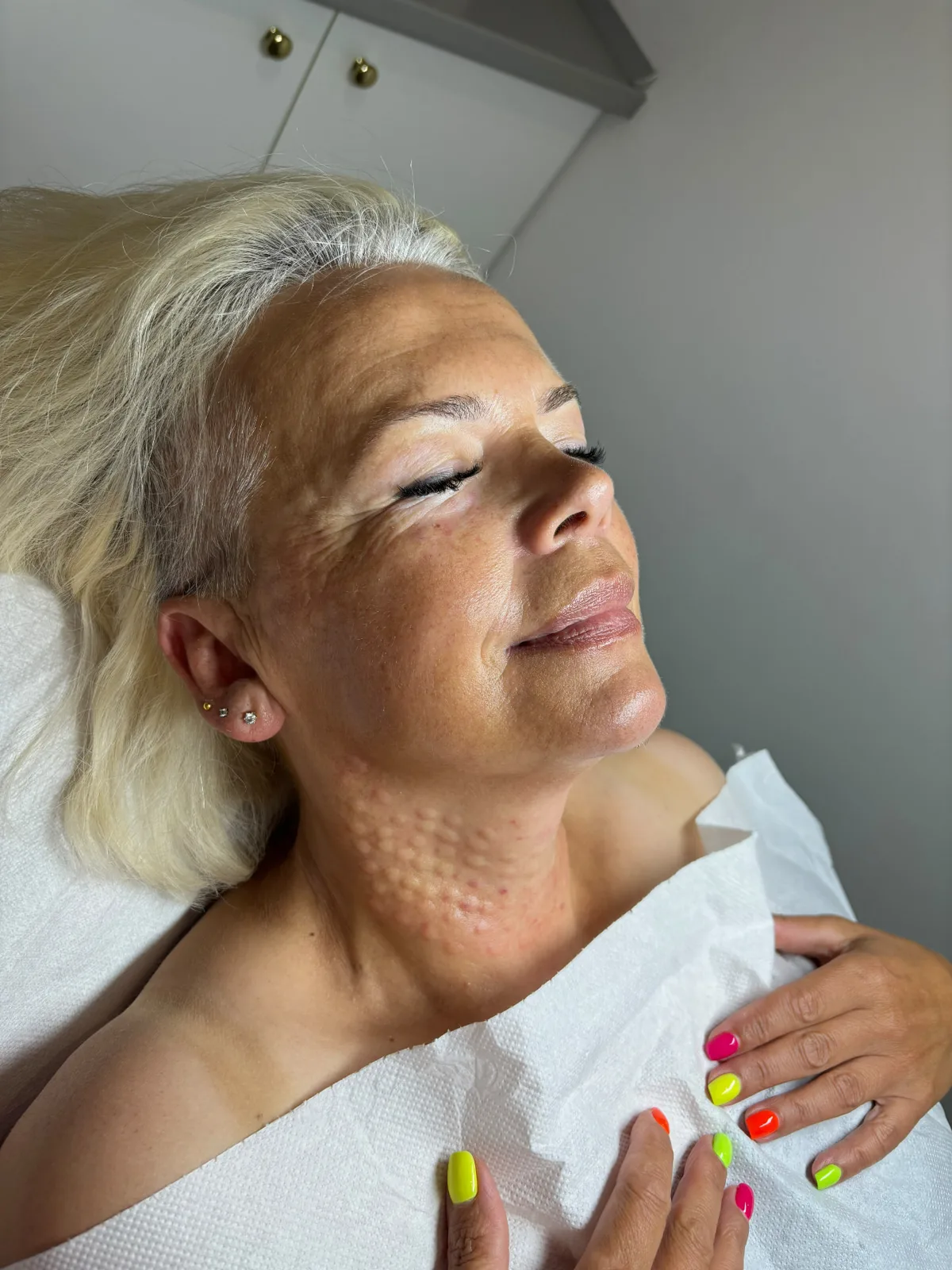Mezoterapia igłowa Piła — Justyna — efekt zabiegu 1, Beauty Station Piła