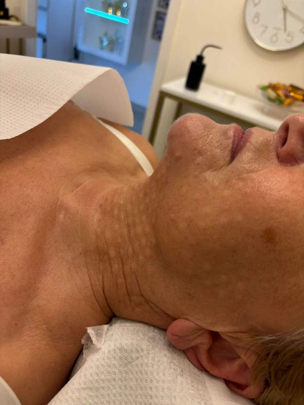 Mezoterapia igłowa Piła — Justyna — efekt zabiegu 2, Beauty Station Piła