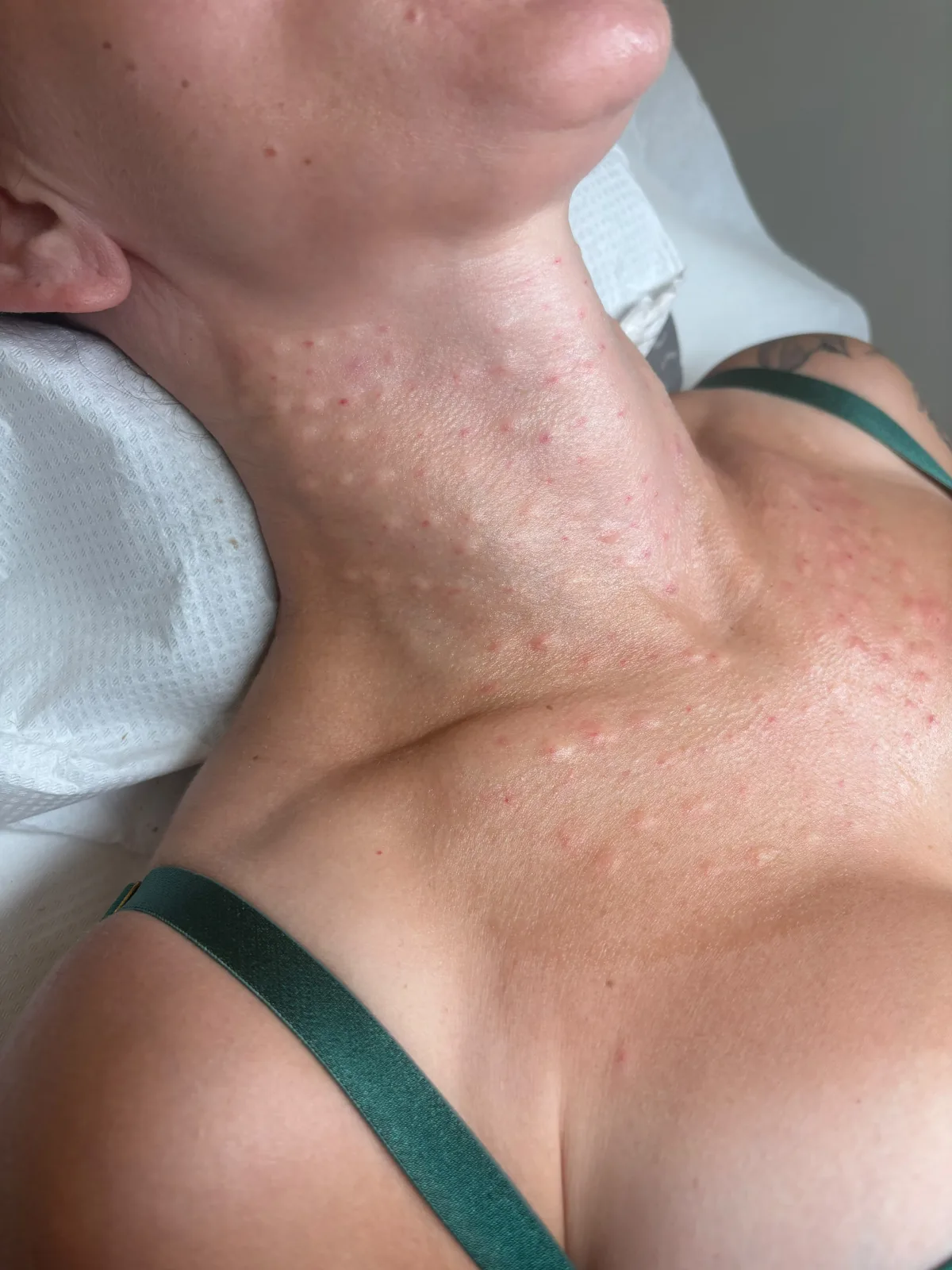 Mezoterapia igłowa Piła — Justyna — efekt zabiegu 3, Beauty Station Piła