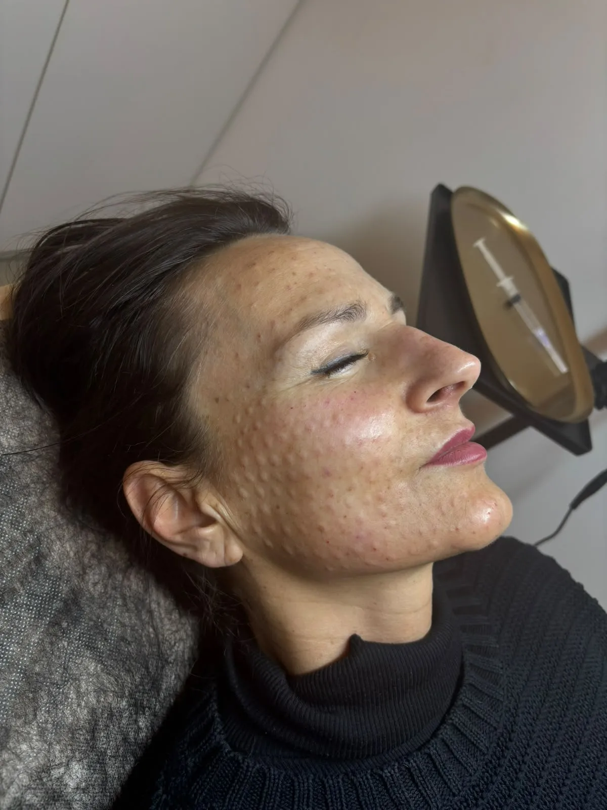 Mezoterapia igłowa Piła — Justyna — efekt zabiegu 4, Beauty Station Piła