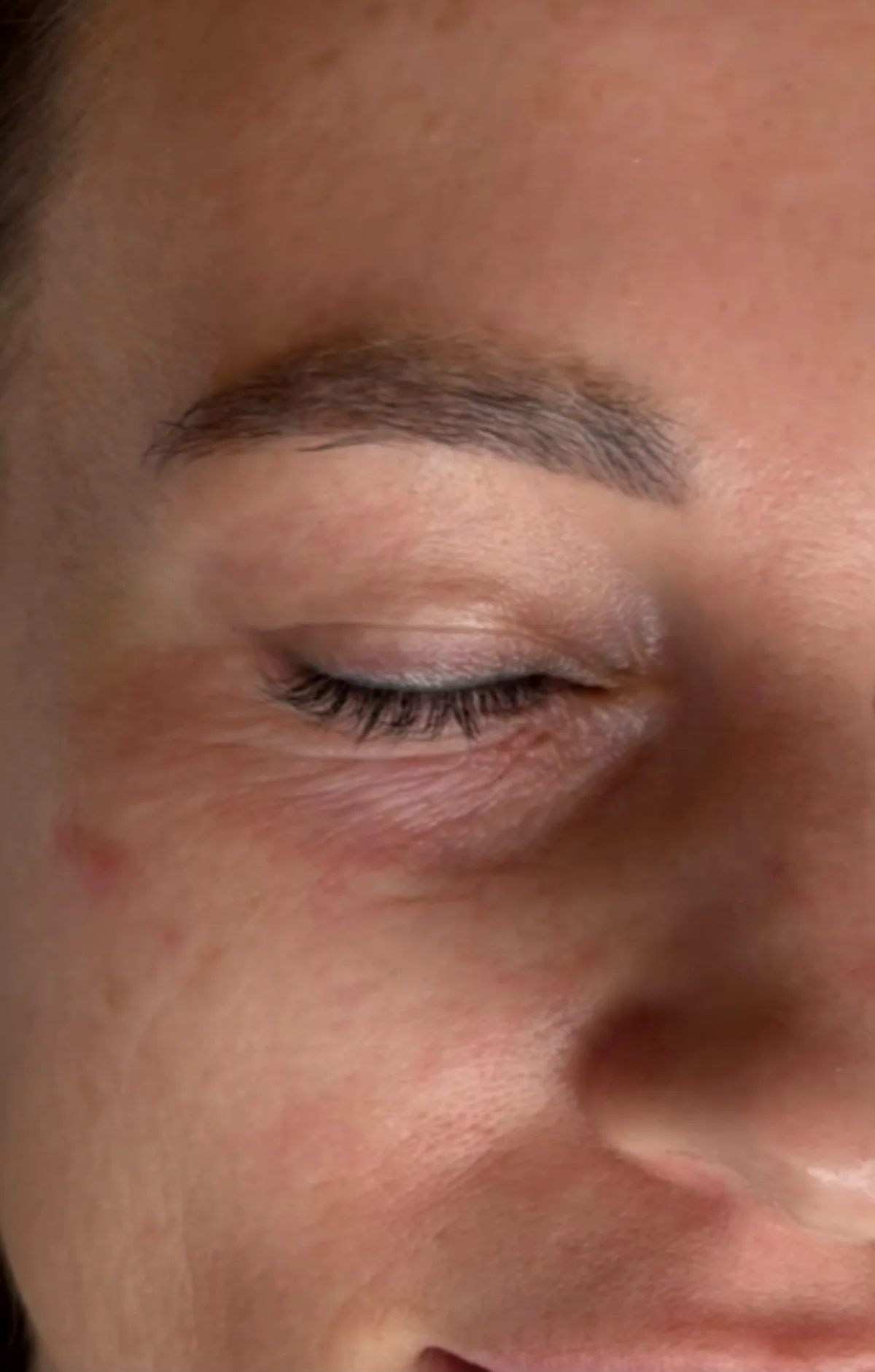 Stymulatory tkankowe — okolica oczu Piła — Justyna — efekt zabiegu 1, Beauty Station Piła