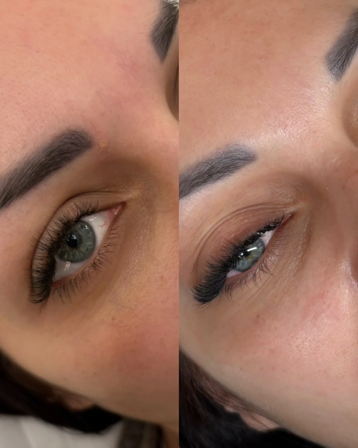 Stymulatory tkankowe — okolica oczu Piła — Justyna — efekt zabiegu 3, Beauty Station Piła