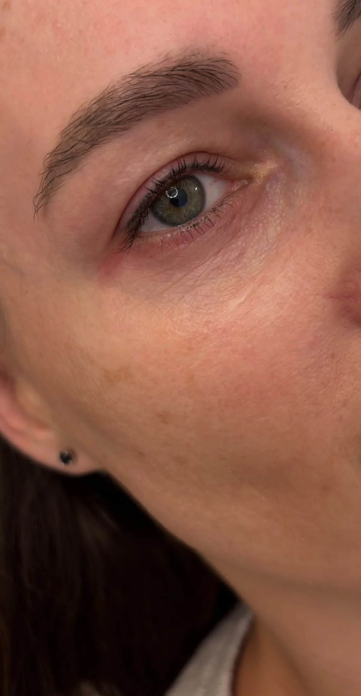 Stymulatory tkankowe — okolica oczu Piła — Justyna — efekt zabiegu 4, Beauty Station Piła