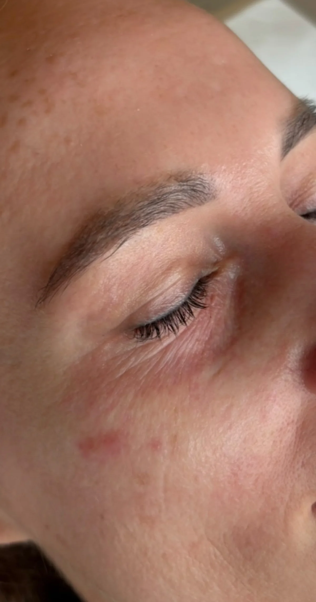 Stymulatory tkankowe — okolica oczu Piła — Justyna — efekt zabiegu 1, Beauty Station Piła
