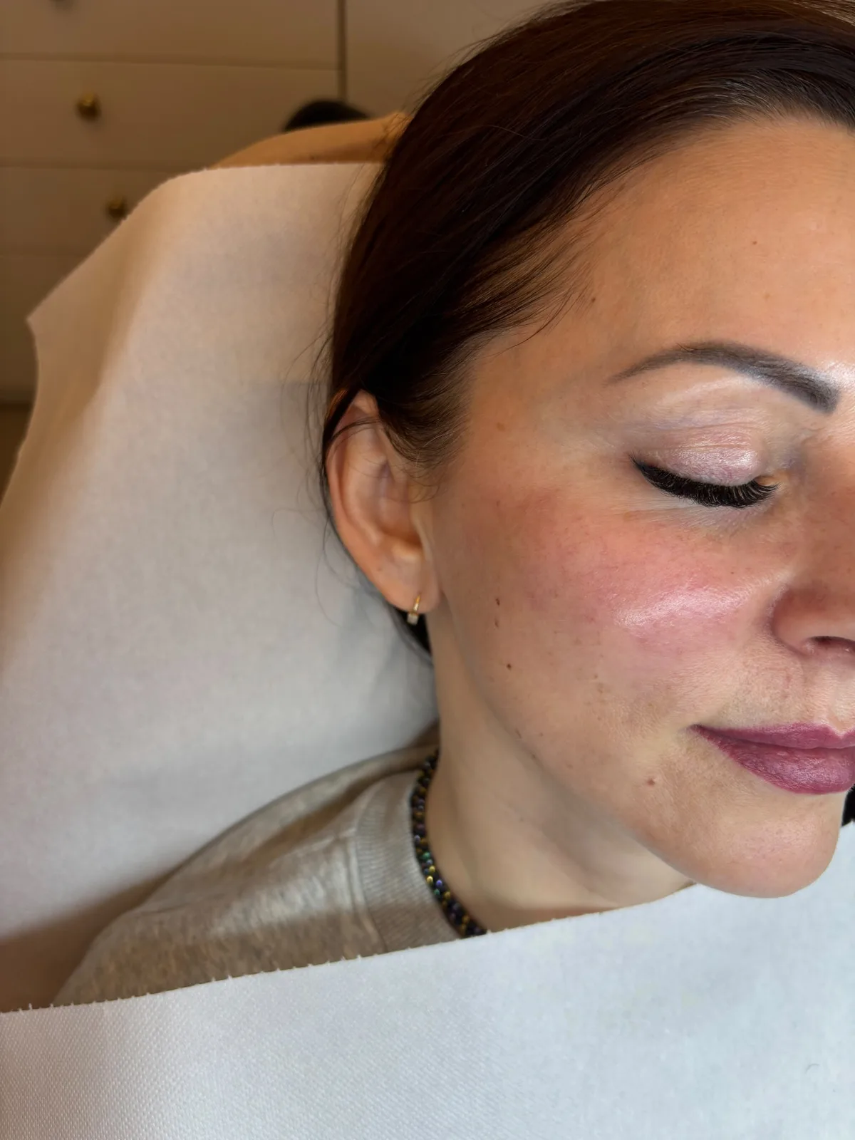 Stymulatory tkankowe — twarz Piła — Justyna — efekt zabiegu 1, Beauty Station Piła