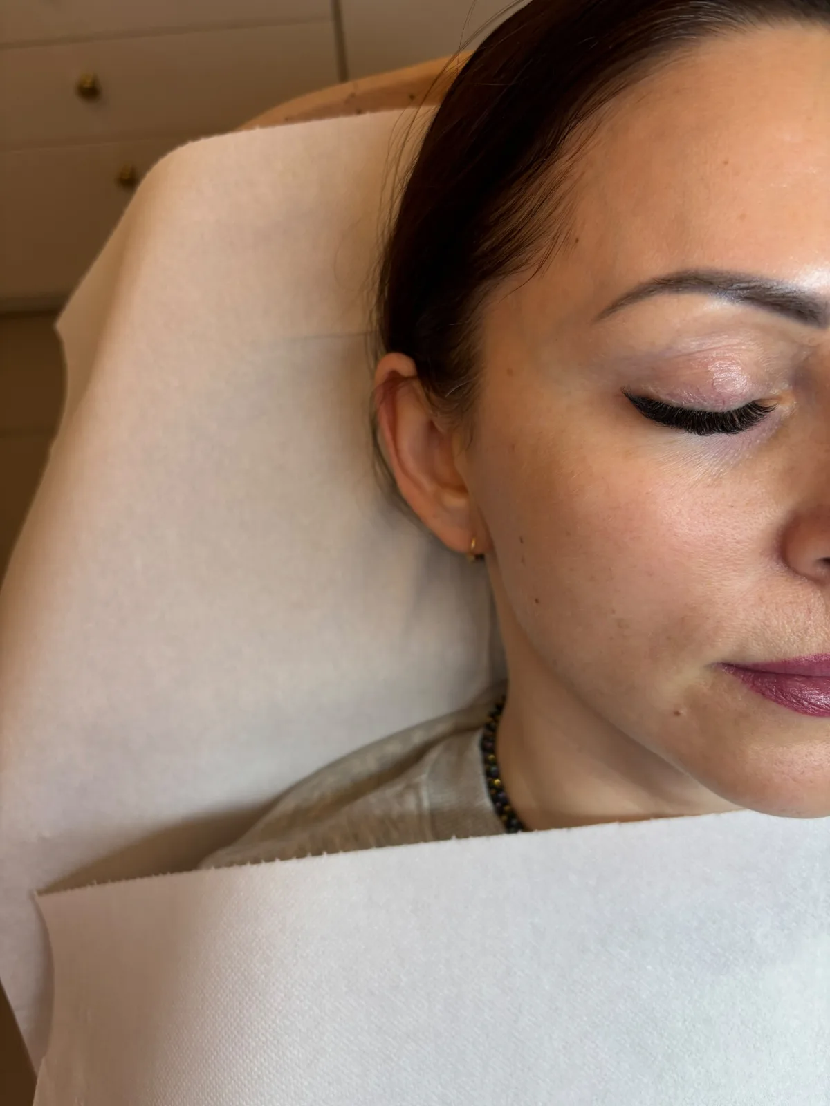 Stymulatory tkankowe — twarz Piła — Justyna — efekt zabiegu 2, Beauty Station Piła