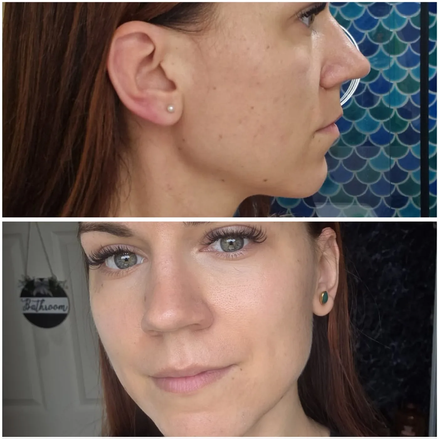 Stymulatory tkankowe — twarz Piła — Justyna — efekt zabiegu 3, Beauty Station Piła