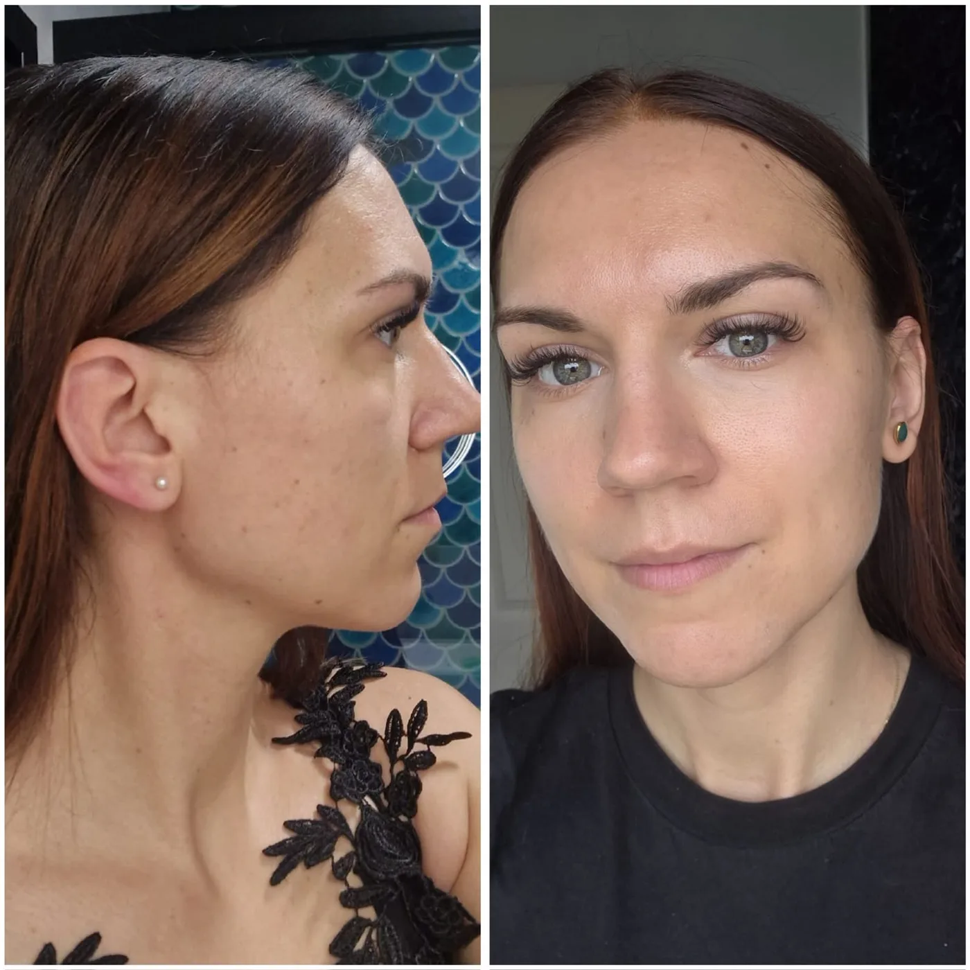 Stymulatory tkankowe — twarz Piła — Justyna — efekt zabiegu 4, Beauty Station Piła