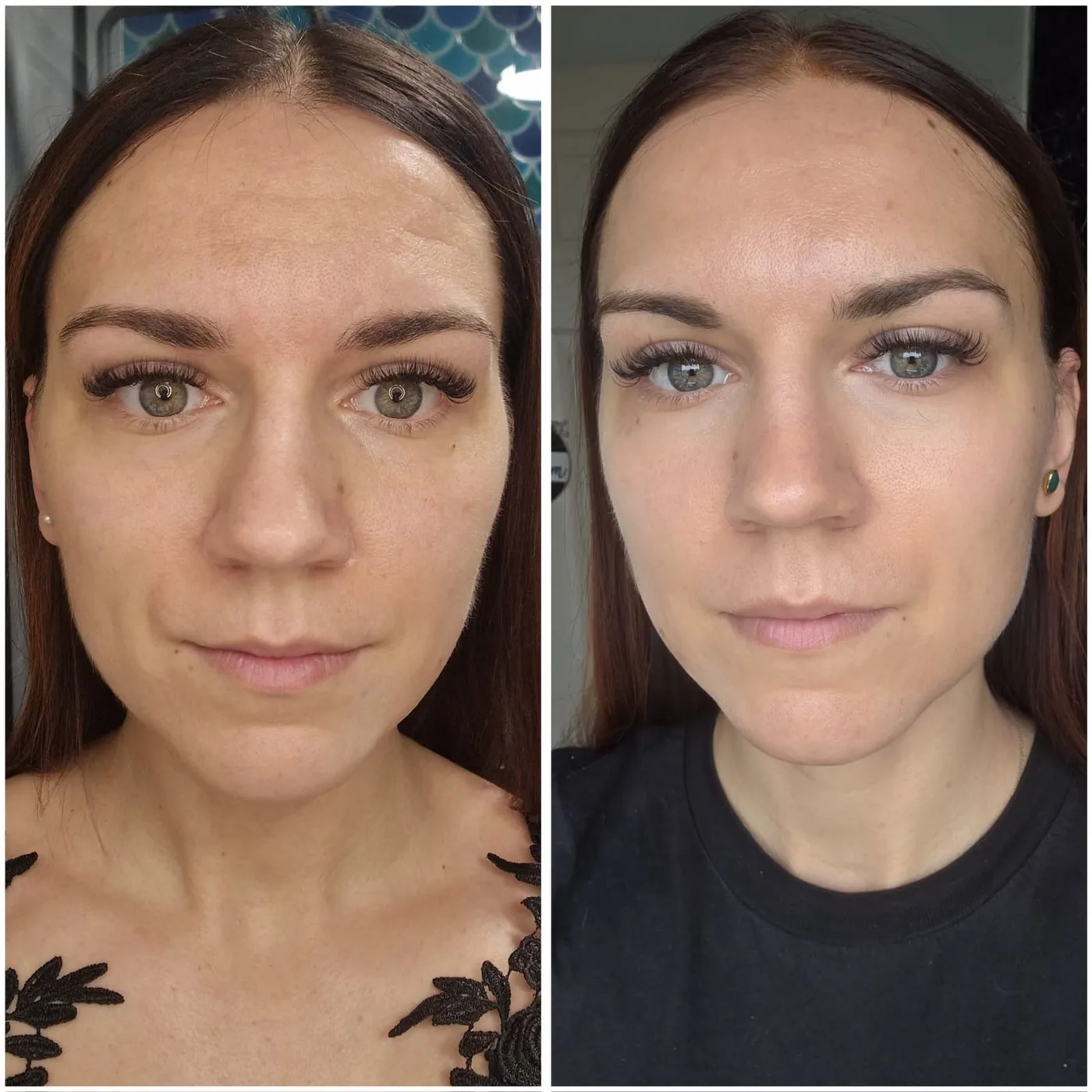Stymulatory tkankowe — twarz Piła — Justyna — efekt zabiegu 1, Beauty Station Piła