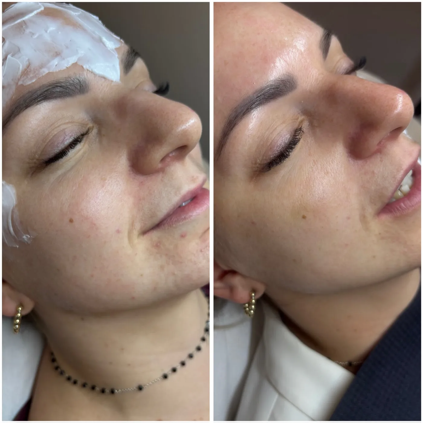 Stymulatory tkankowe — twarz Piła — Justyna — efekt zabiegu 2, Beauty Station Piła