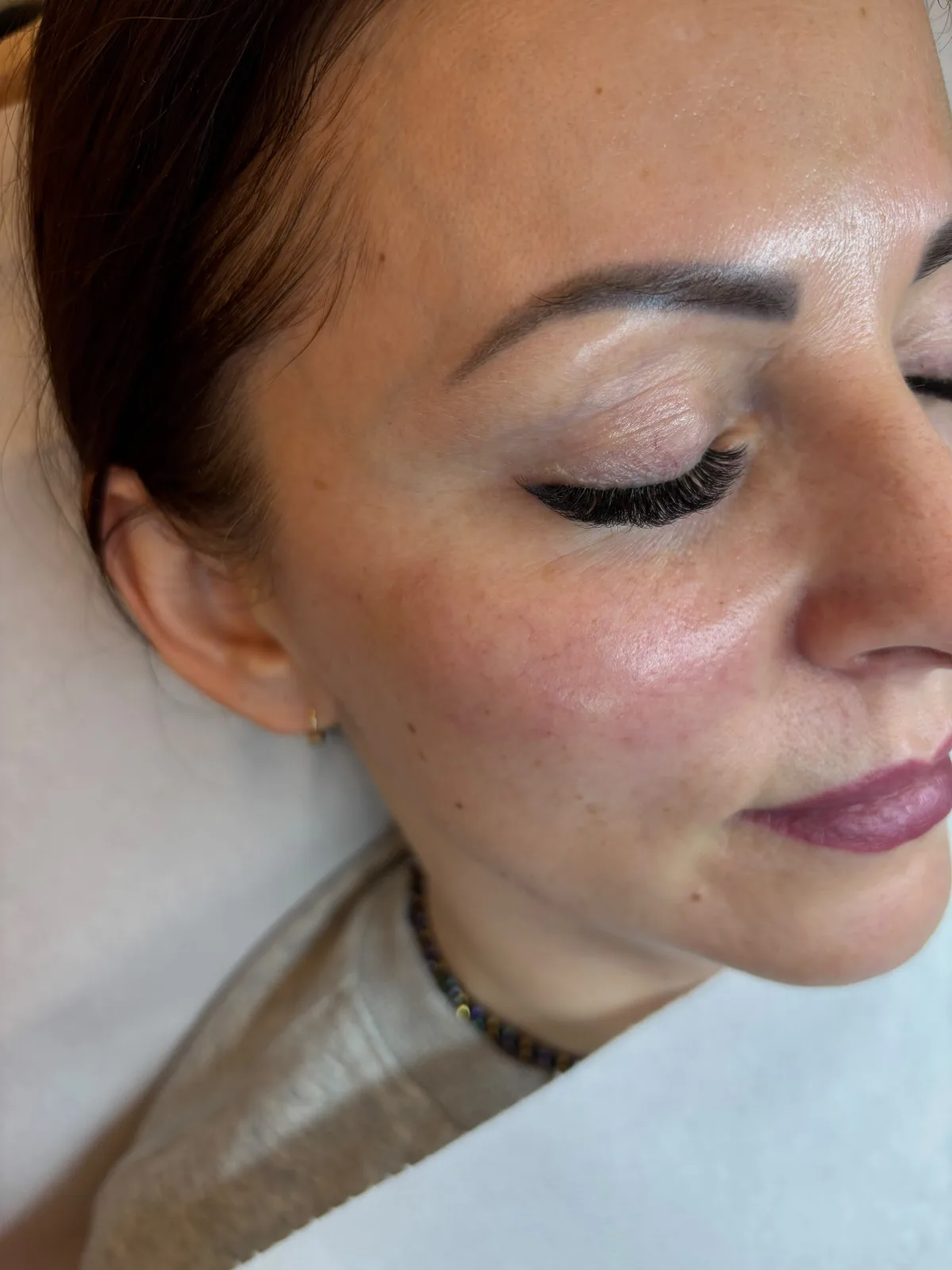 Stymulatory tkankowe — twarz Piła — Justyna — efekt zabiegu 3, Beauty Station Piła